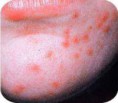 TRATAMIENTOS DE ACNE 